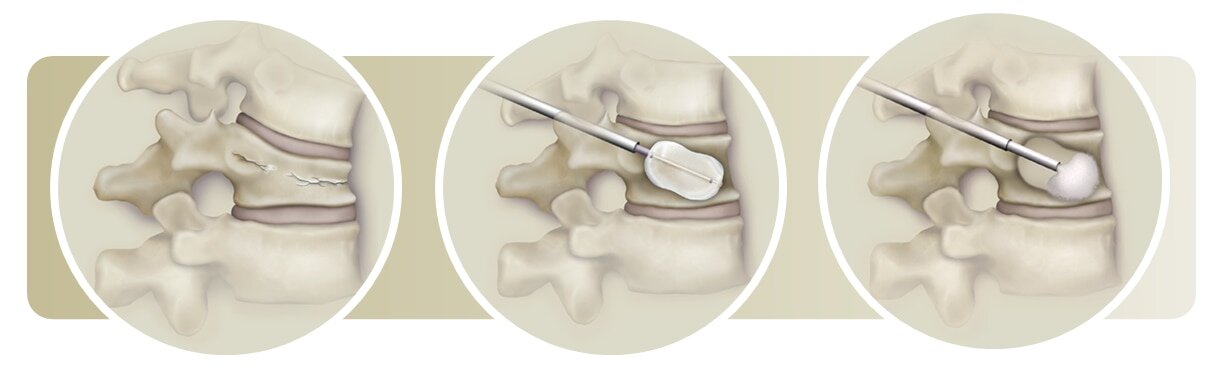 Kifoplasti Vertebroplasti Çökme Kırığı Kemik Erimesi Osteoporoz kifoplasti vertebroplasti ameliyat ücreti