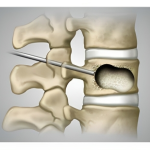 kyphoplasty1