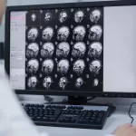 beyin tumor MR emar kanser görüntü evre 1 2 3 4 metastaz sıçrama ömür beklentisi