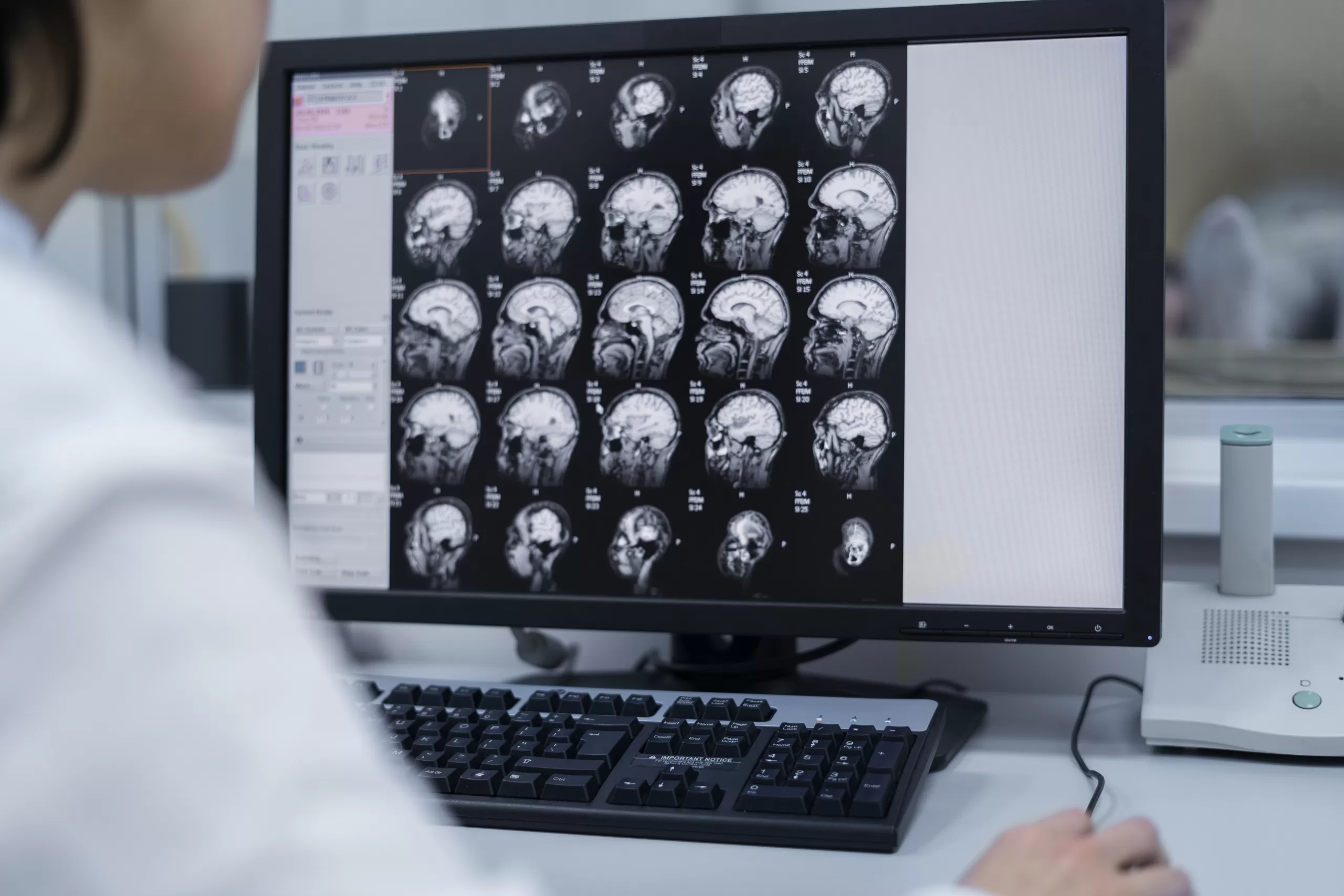 beyin tumor MR emar kanser görüntü evre 1 2 3 4 metastaz sıçrama ömür beklentisi
