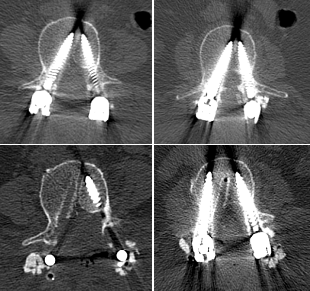 revizyon vida implant enstrumantasyon pedikül yanlış yerleşim fail