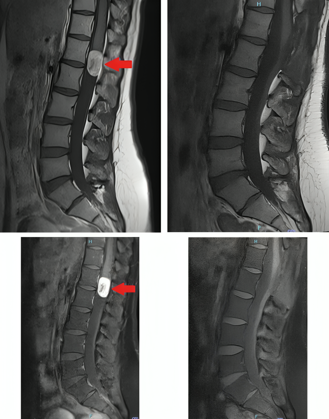 omurilik tümörü spinal kitle schwannom ependimom meningiom felç kuvvet kaybı nöro monitor