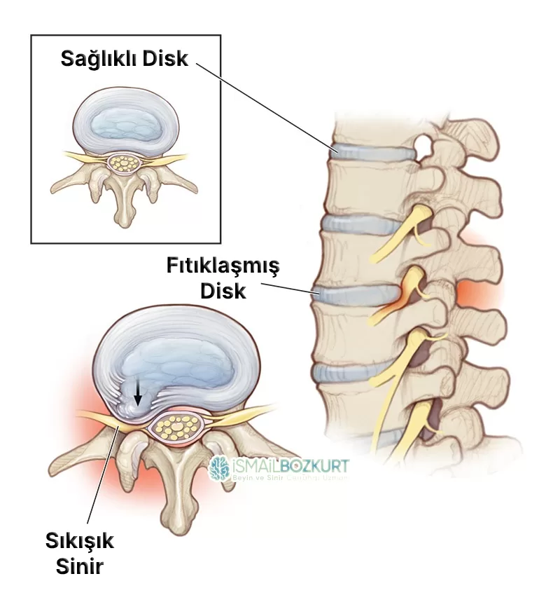 bel fıtığı lomber disk hernisi ekstrude yırtık patlamış sekestre mikrocerrahi kapalı ameliyat tam kapalı endoskopik
