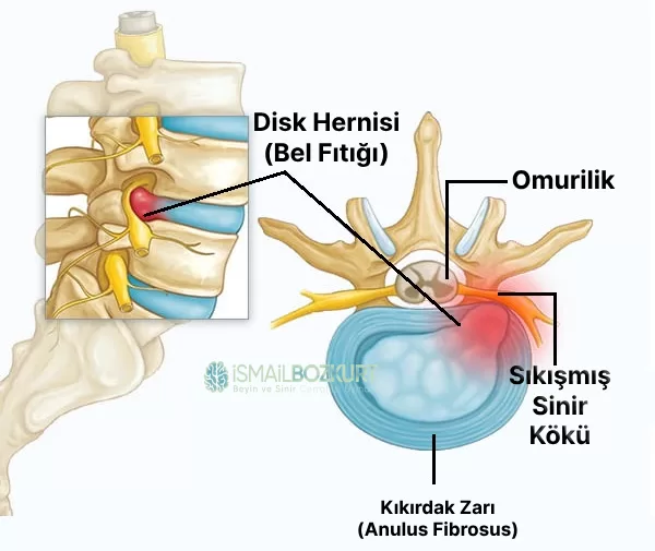 bel fıtığı lomber disk hernisi ekstrude yırtık patlamış sekestre mikrocerrahi kapalı ameliyat tam kapalı endoskopik