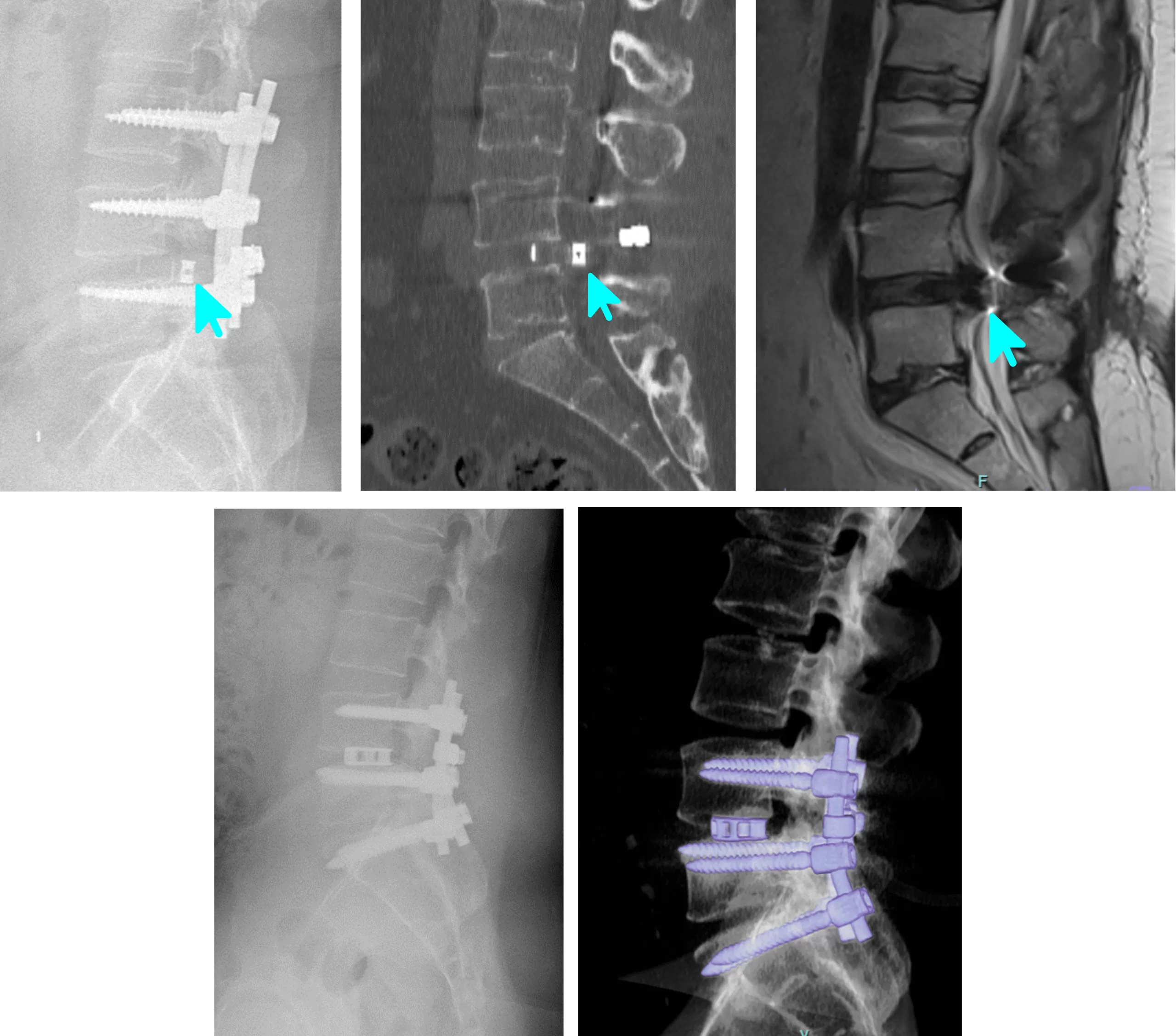 revizyon implant platin titanyum kafes lomber peek cage
