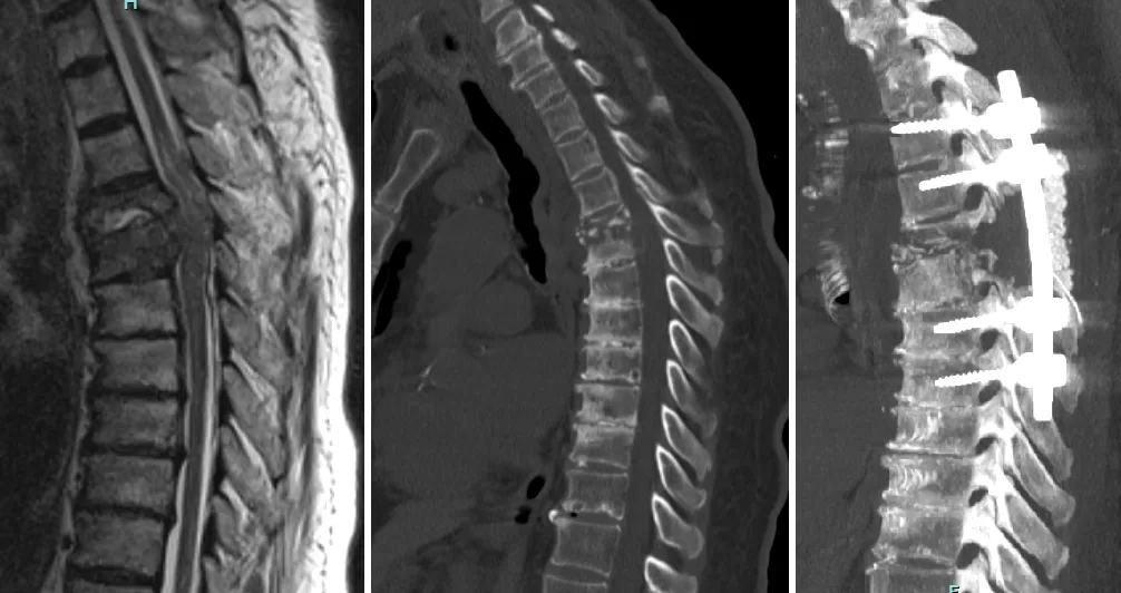 torakal fraktür osteomyelit bakteriyemi enfeksiyon diyaliz omurilik felç