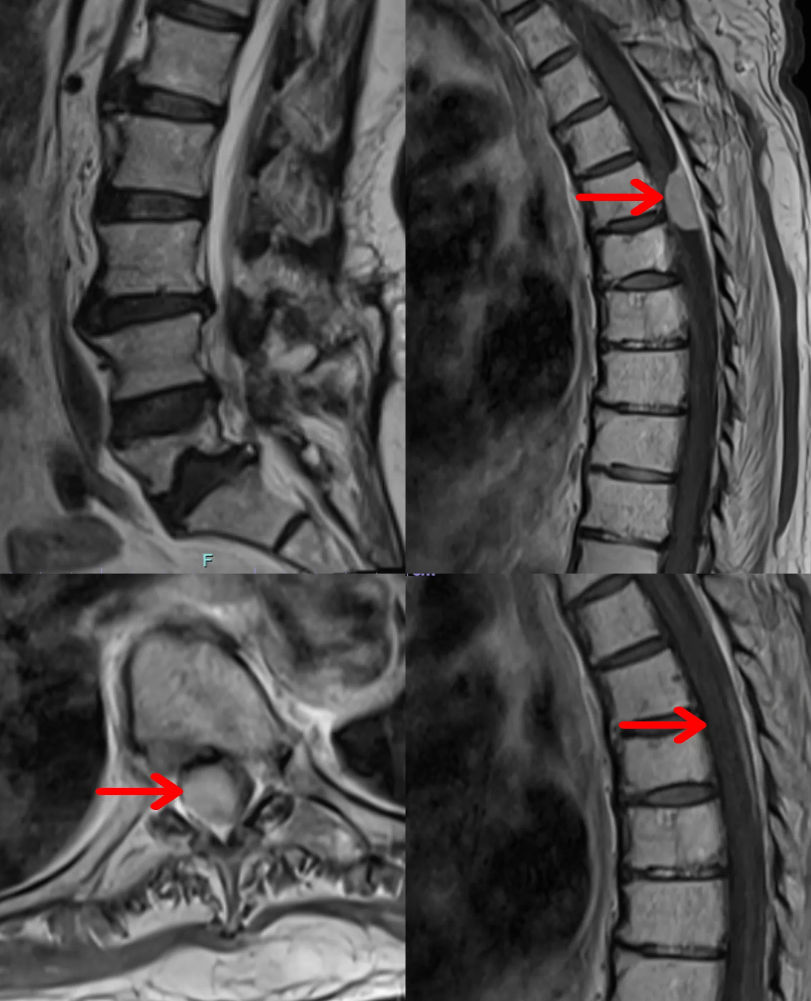 torakal intradural ekstrameduller tumor kitle kanser meningiom felc yanlis ameliyat ankara