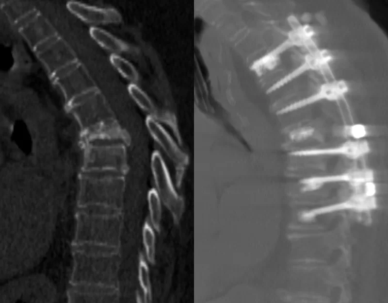 torakolomber torasik osteoporoz kemik erimes cokme kirigi cimento PMMA