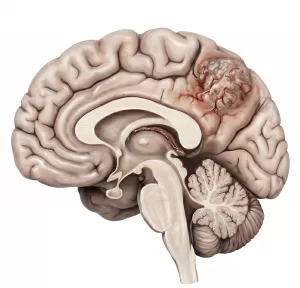 Beyin Tümörü 2 beyin tumor kanser sicrama glioblastom astrositom 1