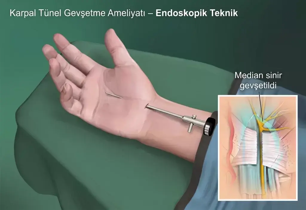 Karpal Tünel Sendromu Nedir ve Sinir Sıkışması Nasıl Oluşur? 5 karpal tunel sendromu endoskopik kapali ameliyat
