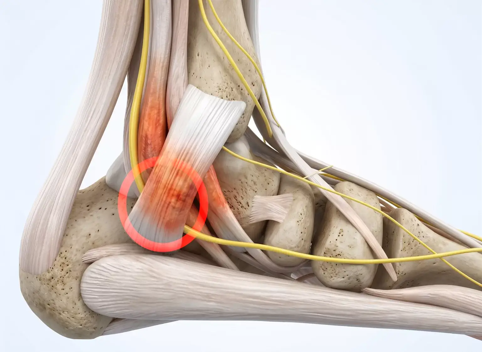 Tarsal Tünel Sendromu Nedir ve Sinir Sıkışması Nasıl Oluşur? 1 Tarsal Tünel Sendromu Nedir ve Sinir Sıkışması Nasıl Oluşur?